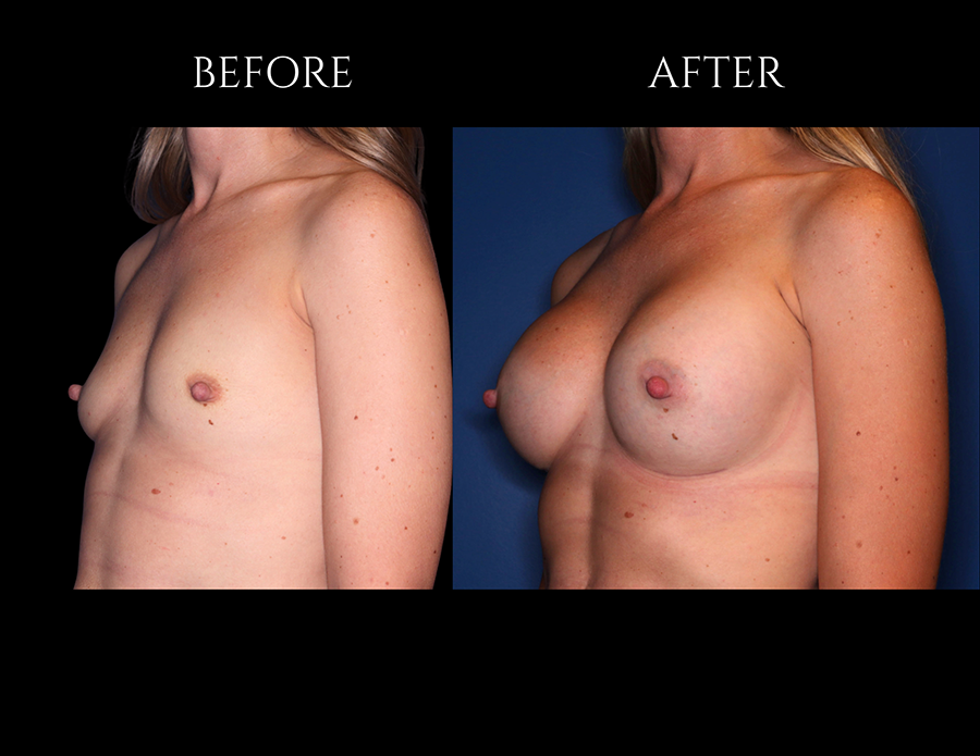 Before and after comparison of a woman’s chest showing the results of breast augmentation surgery.