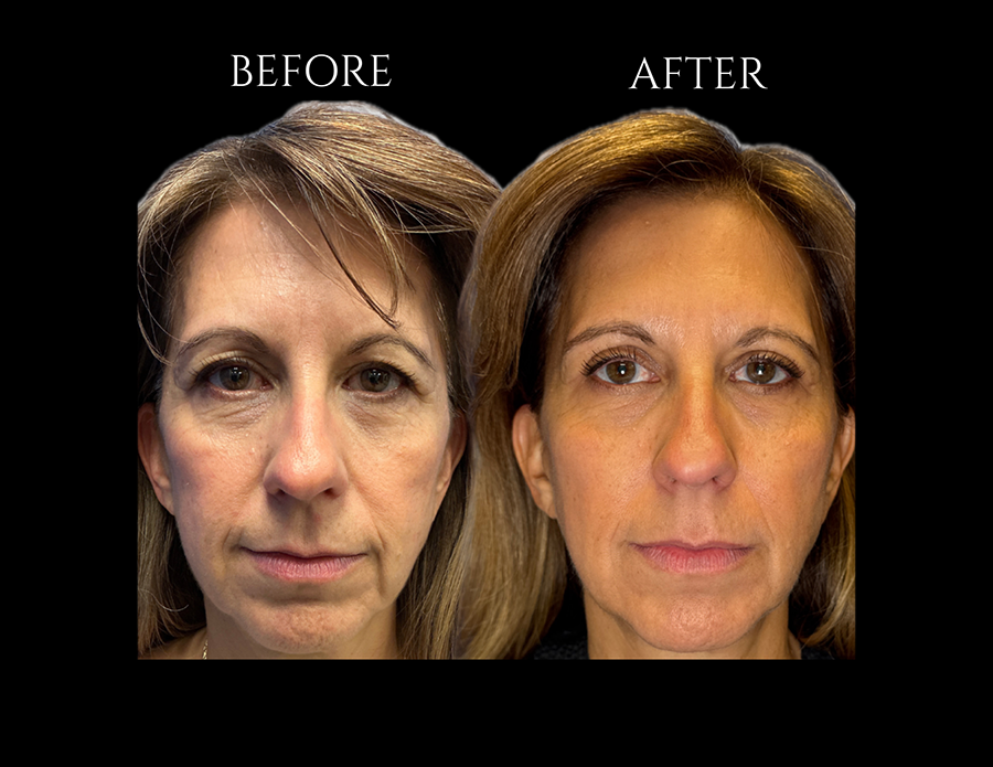 Before and after comparison of a woman’s face showing results of a cosmetic treatment.