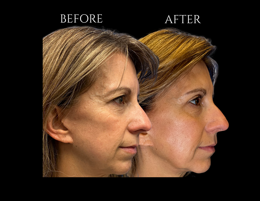 Side-by-side profile comparison of a woman’s face labeled “Before” and “After” a cosmetic procedure.