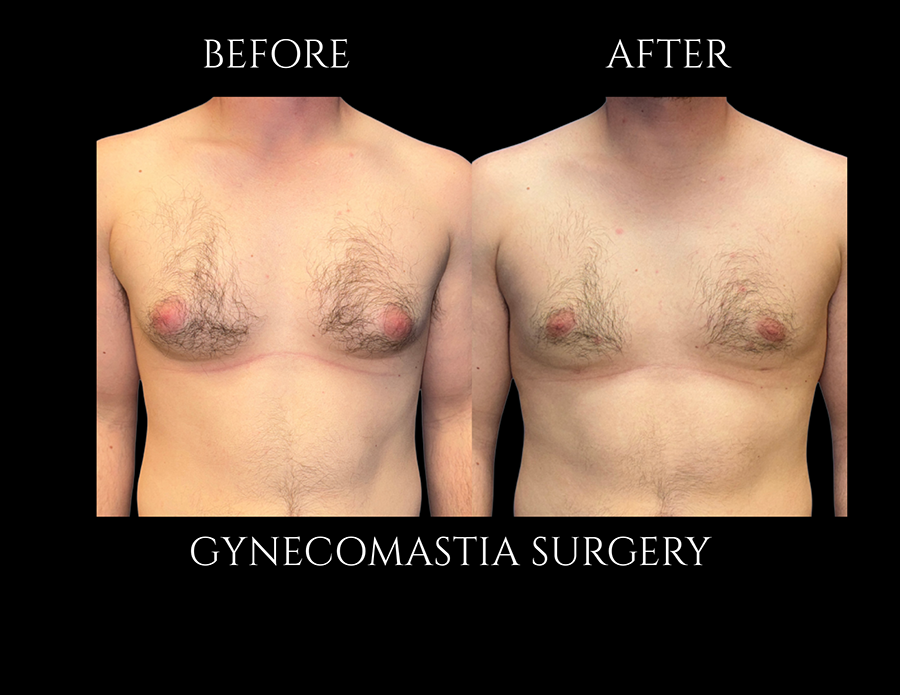 Before and after comparison of a person’s chest showing the results of gynecomastia surgery.