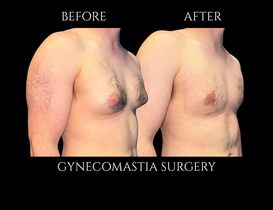 Before and after images of a man’s chest showing the results of gynecomastia surgery.