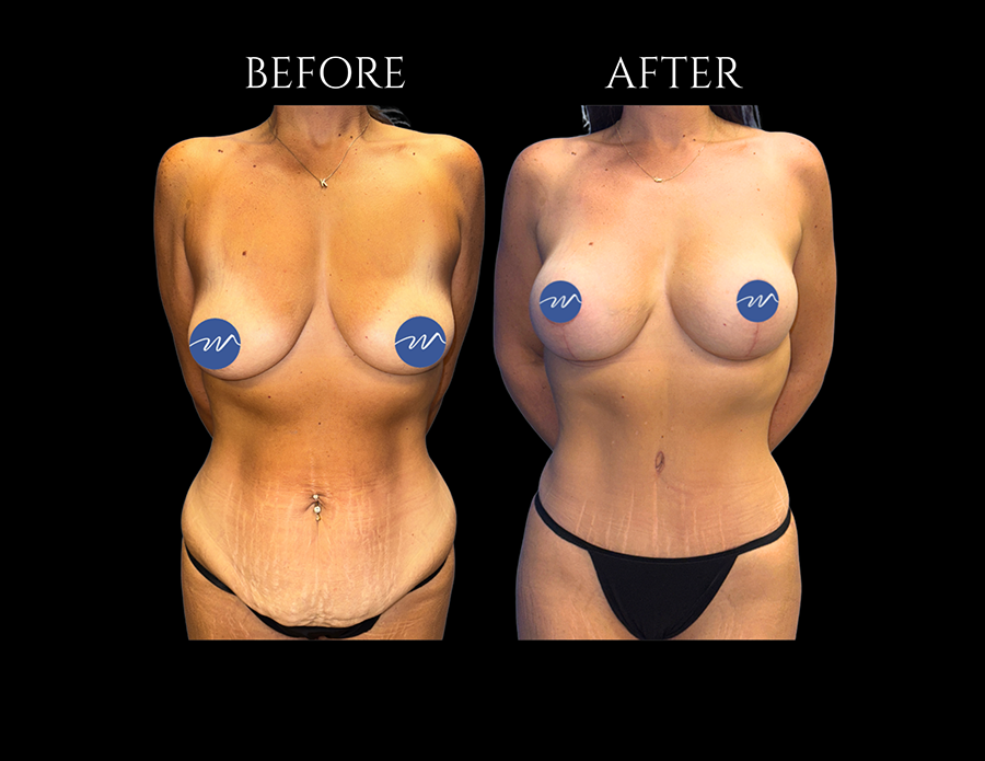 Before and after comparison of a woman’s torso, showing the results of a tummy tuck procedure.