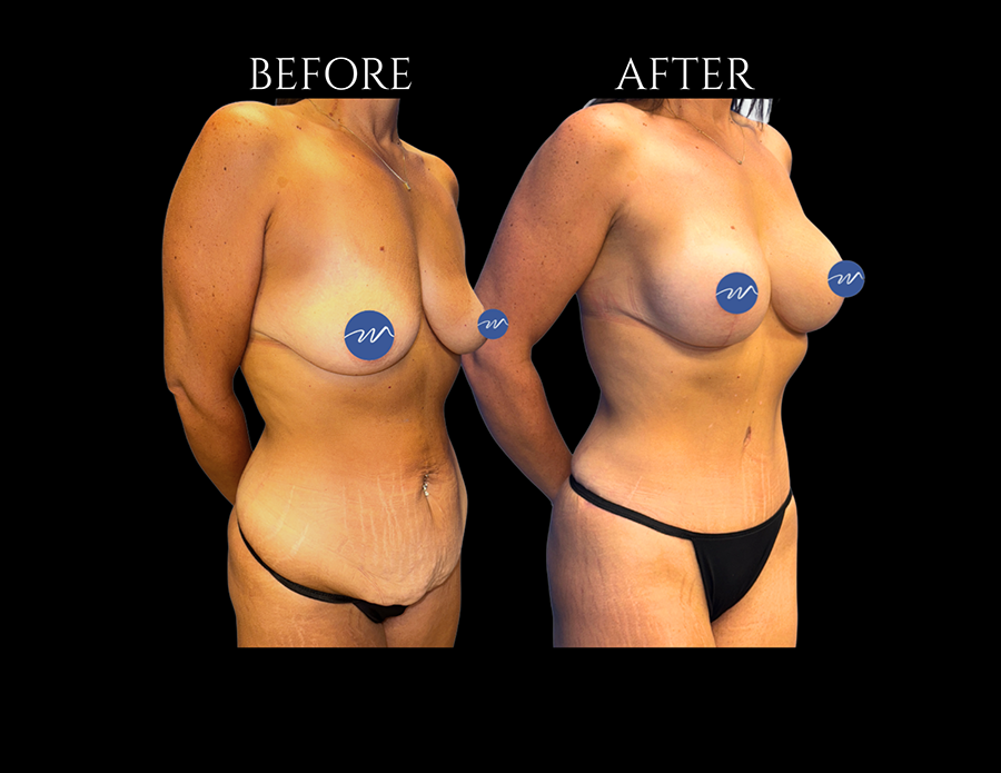 Before and after photos of a patient’s torso and breasts following a surgical procedure.