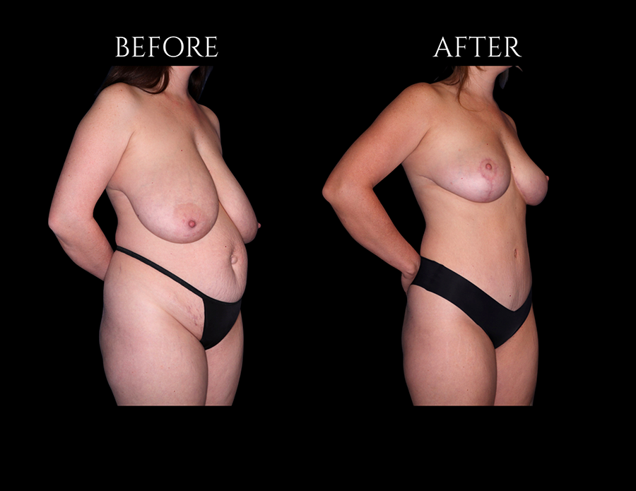 Before and after photos of a person showing the results of a breast lift procedure.