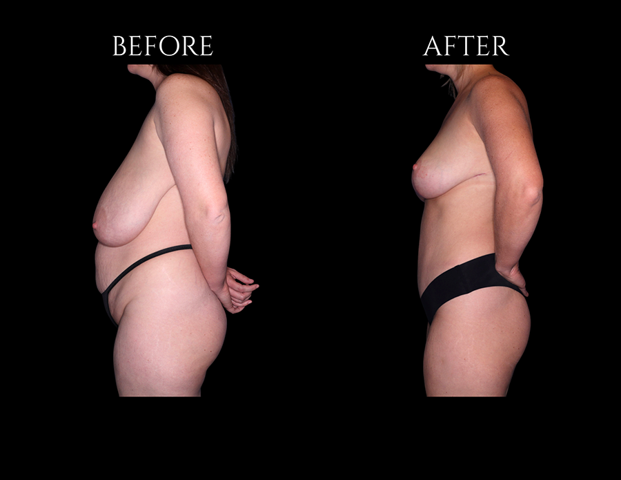 Side-by-side profile view of a woman before and after breast lift surgery.