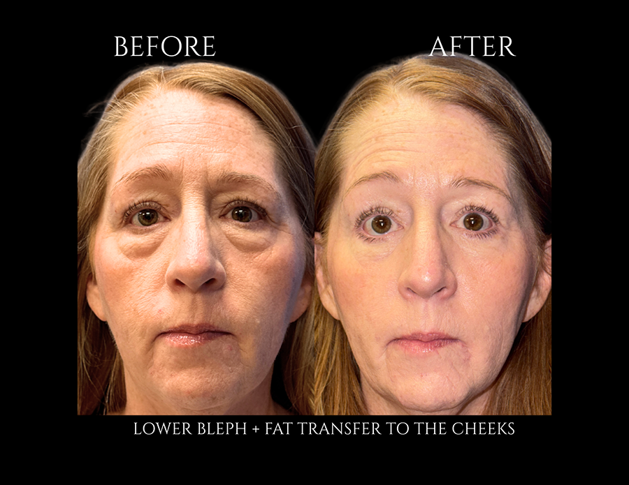 Before and after photos of a woman showing the results of a lower blepharoplasty and fat transfer to the cheeks.