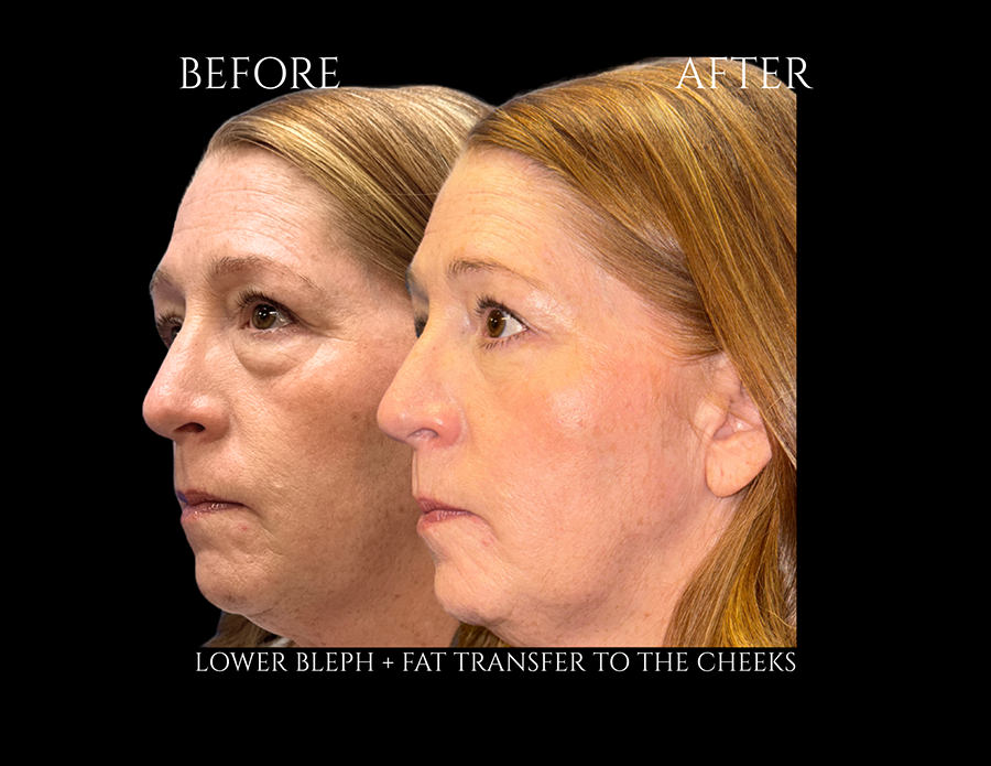 Before and after profile photos of a woman who underwent a lower blepharoplasty and fat transfer to the cheeks.