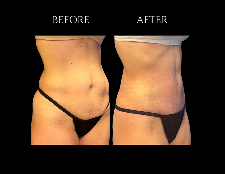 Before and after photos of a person’s midsection showing the results of a cosmetic procedure.
