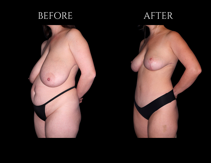 Before and after comparison of a woman’s torso, showing the results of breast reduction surgery.