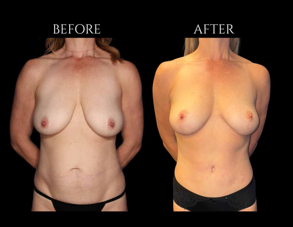 Before and after images of a woman’s torso, showing the results of breast surgery.