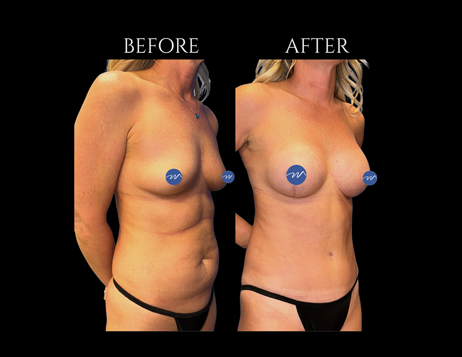 Before and after photos of a patient’s torso, showing the results of a breast lift and abdominal surgery.