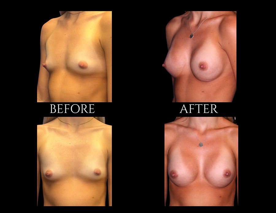 Before and after photos of a breast augmentation procedure shown from side and front profiles.