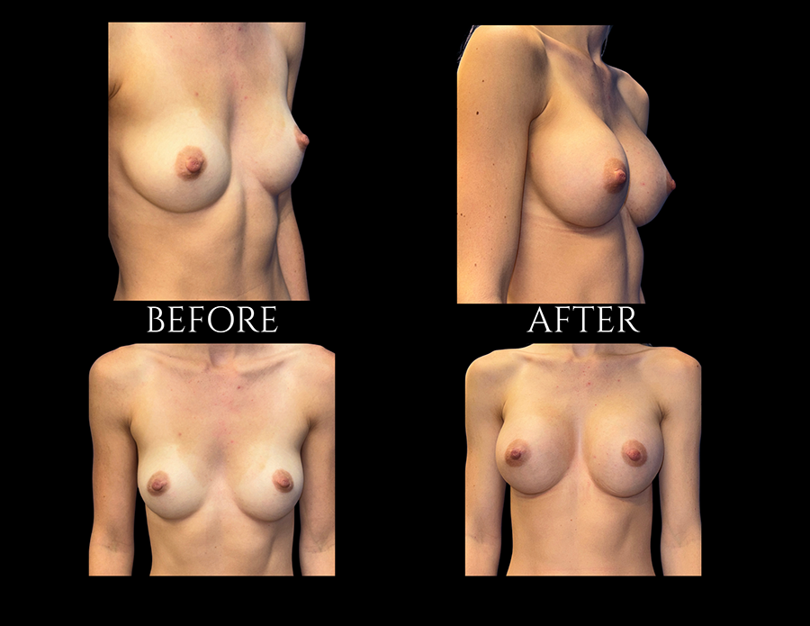 Before and after photos of a breast augmentation procedure shown from side and front profiles.
