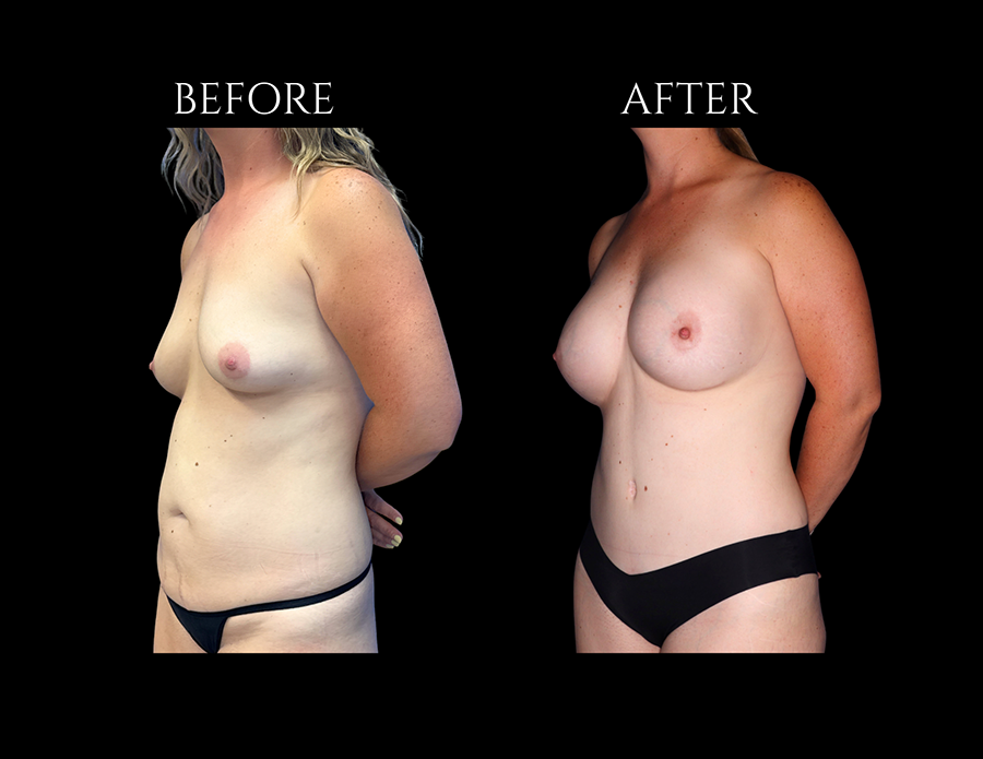 Side-by-side comparison of a patient’s torso before and after a breast augmentation procedure.