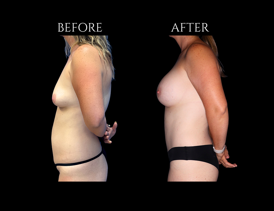Side-by-side comparison of a woman’s torso before and after breast augmentation surgery, shown in profile against a black background.