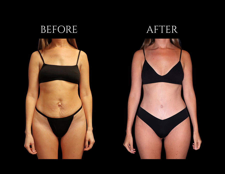 Before and after comparison of a woman’s midsection, showing skin tightening and reduction of abdominal laxity after a procedure.