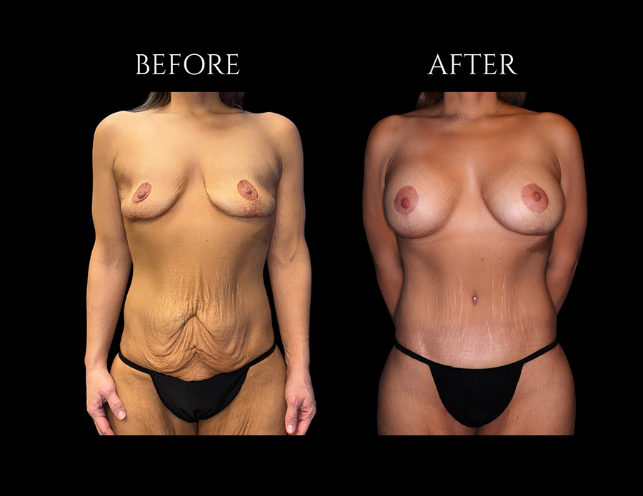 Before and after comparison of a woman’s torso showing the results of a breast lift and tummy tuck procedure.
