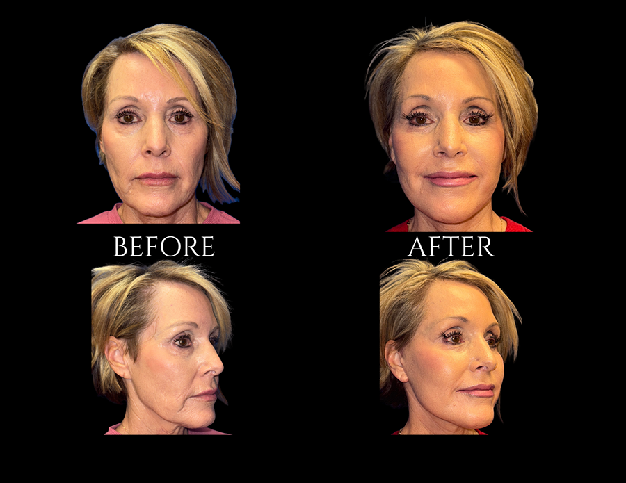 Before and after comparison photos of a woman’s face, showing front and profile views.