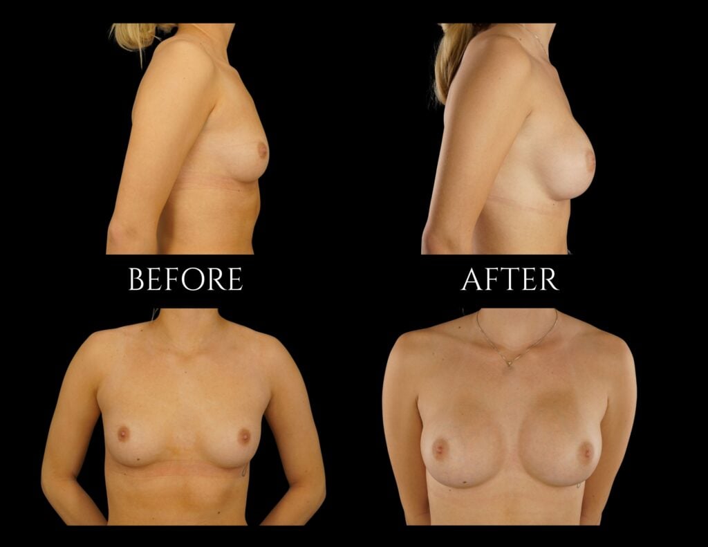 Before and after comparison of breast augmentation surgery showing side and front views of the same person.