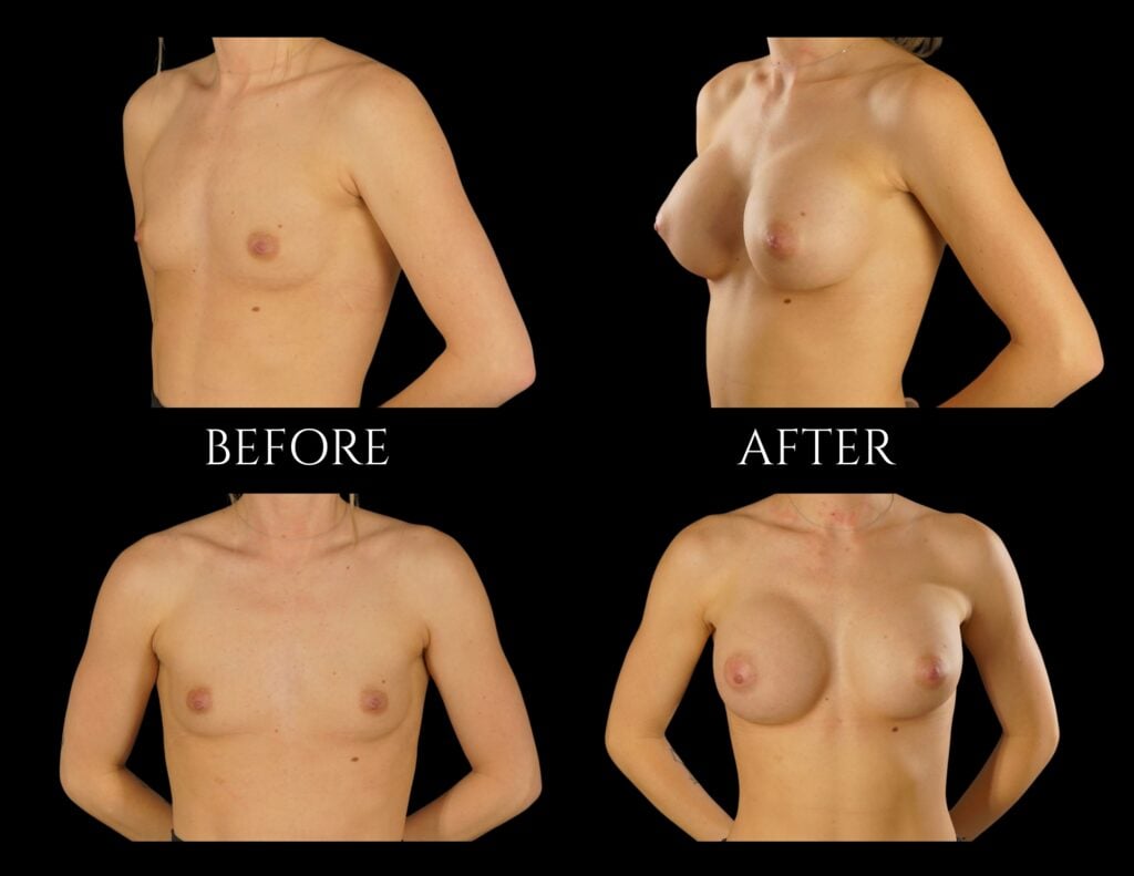 Before and after comparison of a person’s chest showing the results of breast augmentation surgery.