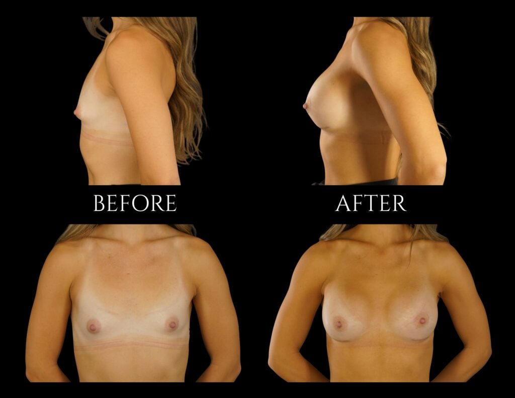 Before and after photographs showing the results of a breast augmentation procedure from front and side profiles.