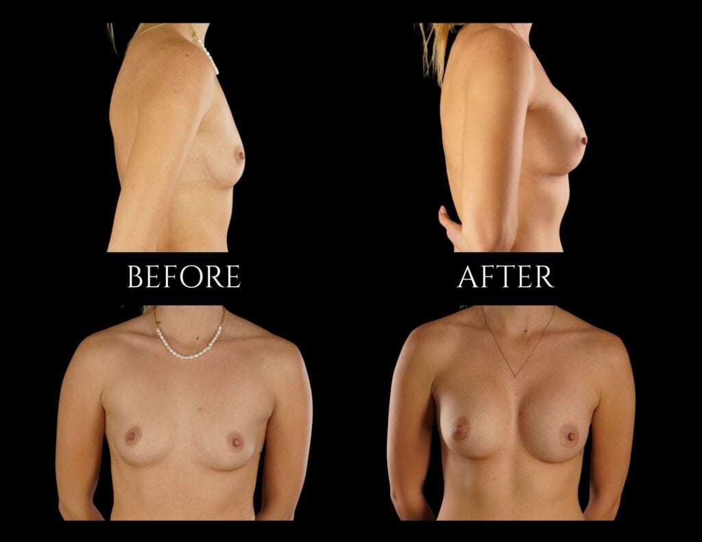 Before and after comparison of a patient’s chest showing the results of breast augmentation surgery from front and side views.