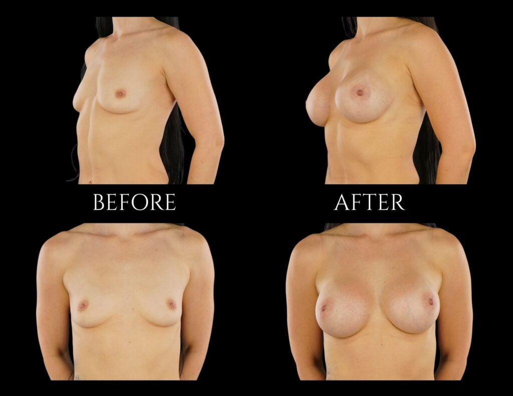 Before and after images of a patient’s chest showing the results of breast augmentation surgery from profile and front views.