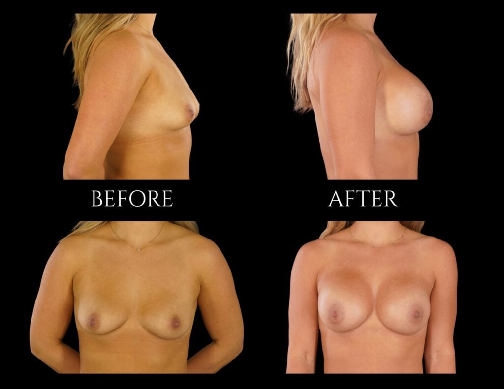 Before and after photos of a patient’s breast augmentation surgery, shown from profile and front views.