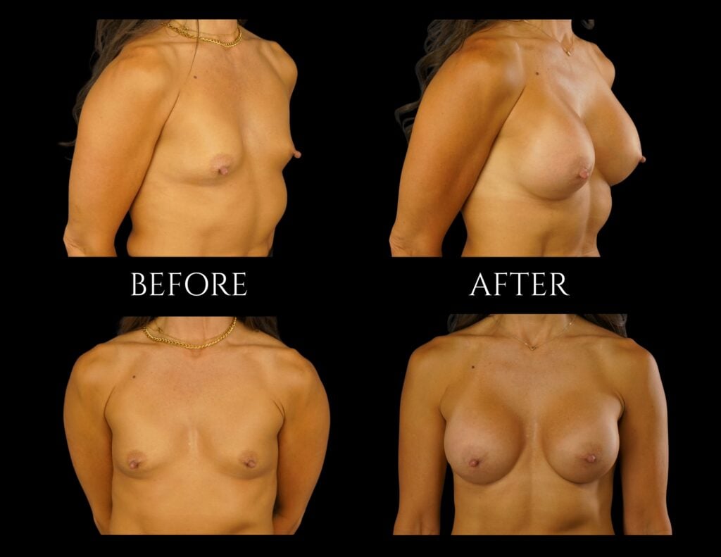 Before and after comparison photos of a patient showing the results of breast augmentation surgery from front and side views.