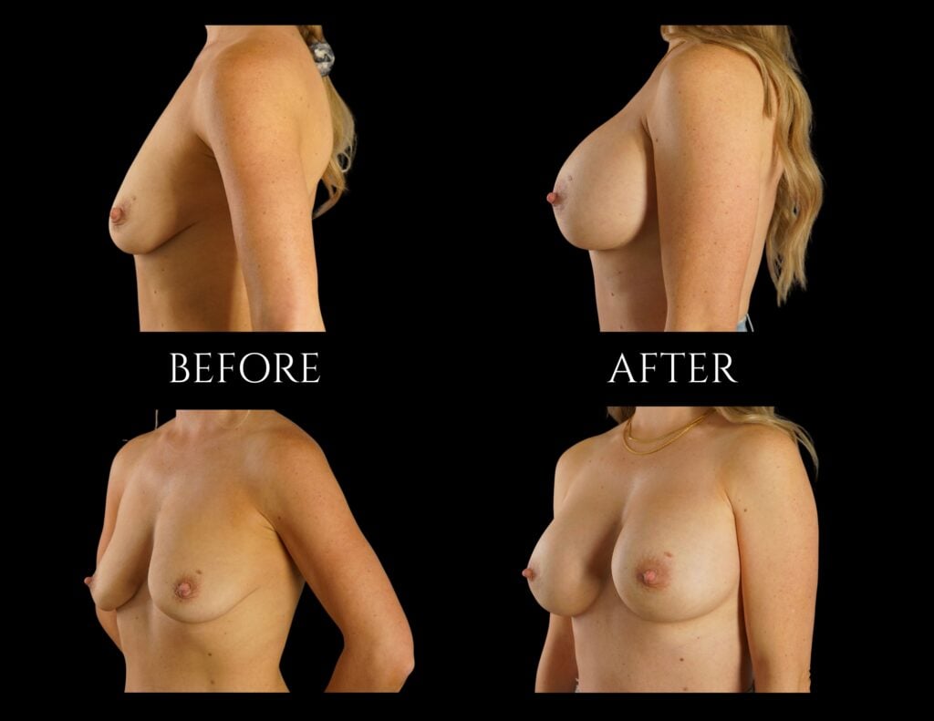 Before and after photographs showing the results of a breast augmentation surgery from profile and three-quarter angles.