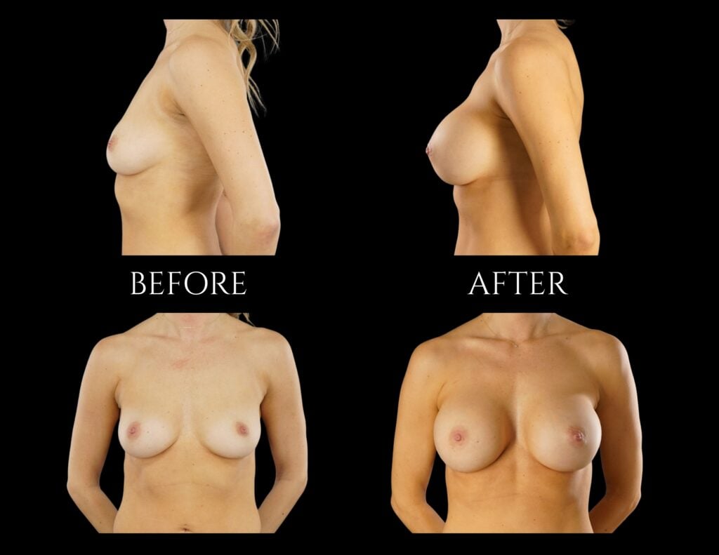 Before and after images of a patient’s chest showing the results of breast augmentation surgery from both side and front profiles.
