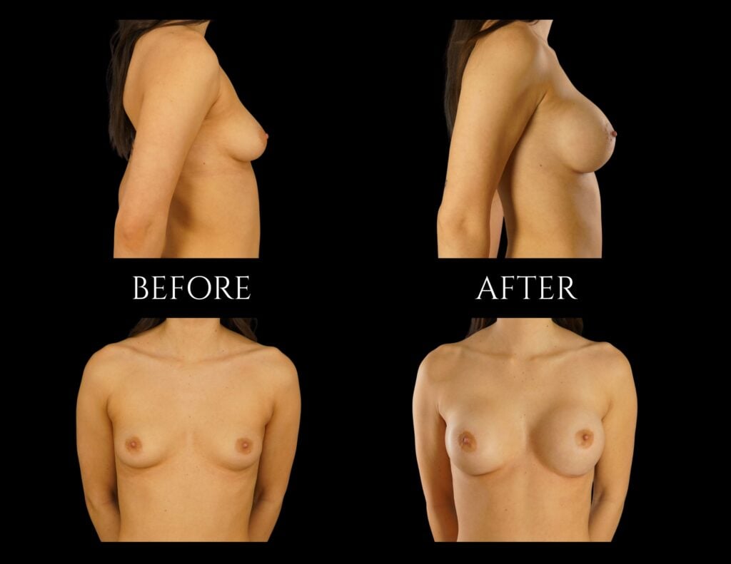 Before and after side and front views of a breast augmentation surgery.