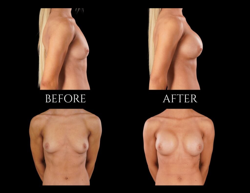 Before and after photos of a person shown from the side and front, demonstrating the results of breast augmentation surgery.