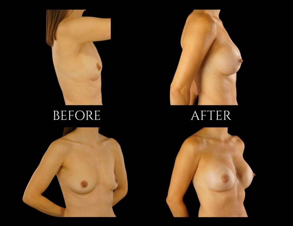 Before and after photos of a breast augmentation procedure shown from side and front profiles.
