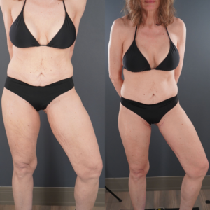 Woman in black bikini shown in two side-by-side images, displaying changes in skin tightness and body contour, standing against a gray wall.