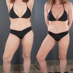 Side-by-side photos of a woman in a black bikini before and after a body transformation, showing visible changes in her abdomen, thighs, and hips.