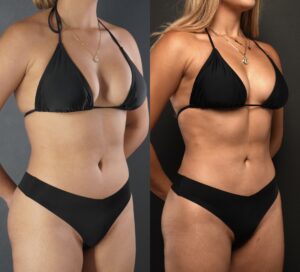 Side-by-side photos of a woman in a black bikini, showing her torso and arms, with slight differences in lighting and body posture between the two images, featured as part of Dr Moores Gallery.