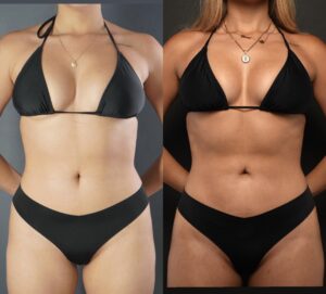 Two women shown from shoulders to hips, both wearing black bikini tops and bottoms, stand against plain backgrounds in this striking image from Dr Moores Gallery.