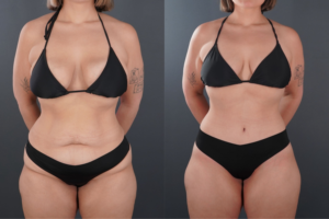 A woman in a black bikini is shown in two side-by-side photos, with the right image displaying a slimmer and more toned appearance than the left.