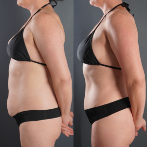 Side-by-side images of a woman in a black bikini, showing body changes before and after; the after image displays a slimmer waist and flatter abdomen.