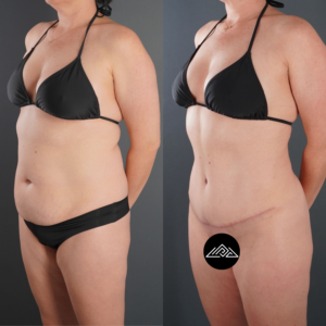 Woman in a black bikini shown in before and after photos; after photo displays a flatter abdomen and visible surgical scar.