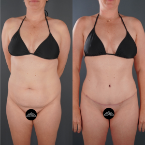 Woman in a black bikini shown before (left) and after (right) abdominal surgery, with visible changes in body contour and a surgical scar.