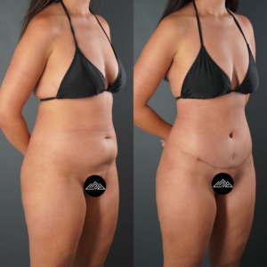 Side-by-side comparison of a woman in a black bikini before and after a body contouring surgery, showing reduced abdominal fullness and a scar on the right image.