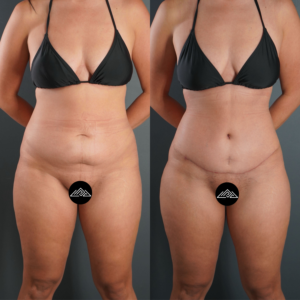Side-by-side comparison of a woman’s abdomen and thighs before (left) and after (right) an aesthetic procedure, wearing a black bikini.