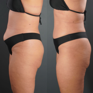 Side-by-side comparison of a woman’s torso and upper legs before and after a body contouring procedure, showing reduced abdominal and thigh size.