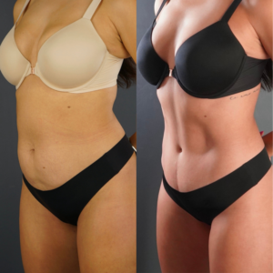 Side-by-side comparison of a woman’s torso before and after a body contouring procedure, showing changes in abdominal shape and skin tightness.
