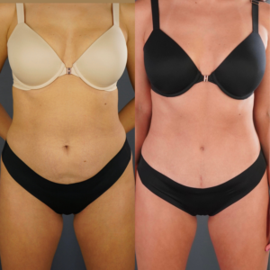 Two side-by-side photos show a woman in underwear before and after a body transformation, displaying changes in abdominal appearance.