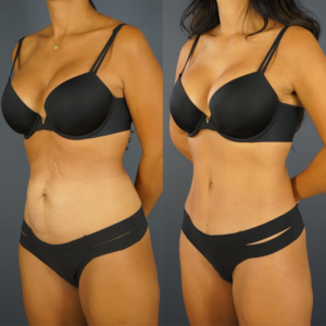 Side-by-side comparison of a woman in black underwear showing her torso before and after a cosmetic procedure, with visible changes to skin smoothness and body contour.