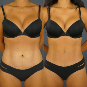 Side-by-side photos of a woman in black underwear, showing her abdomen before (left, with loose skin) and after (right, with smoother, firmer skin) a cosmetic procedure.