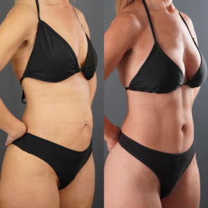 Side-by-side photos of a woman in a black bikini, showing her body before (left) and after (right) a noticeable transformation, with improved muscle tone and reduced abdominal fat.